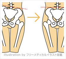 骨盤矯正